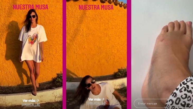 Irene Rosales en el momento de la caída y cómo quedó su pie / Instagram