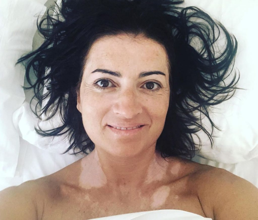 Silvia Abril sin ocultar su vitíligo/ Foto: Instagram