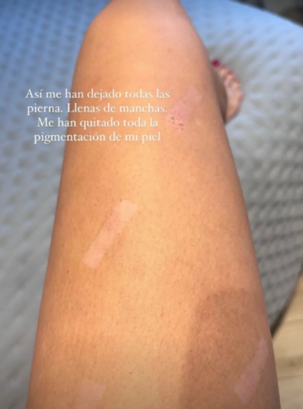 Adara enseña cómo se le han quedado las piernas | Foto: Instagram