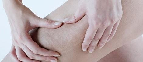 Los cinco mitos sobre la celulitis