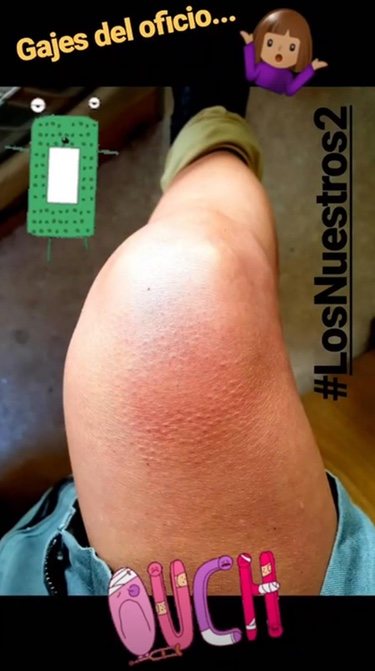 Las heridas de Paula Echevarría en el rodaje de 'Los Nuestros 2'/ Foto: Instagram