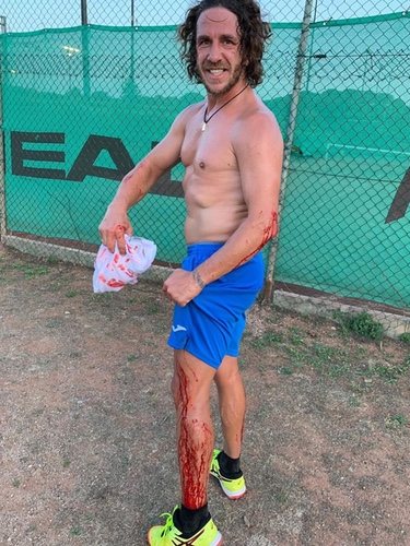 Carles Puyol enseñando sus heridas/ Foto: Instagram