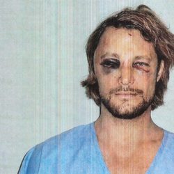 Gabriel Aubry muestra su rostro tras la pelea con Olivier Martínez