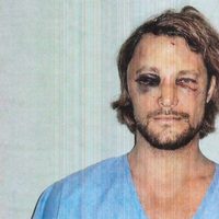 Gabriel Aubry muestra su rostro tras la pelea con Olivier Martínez