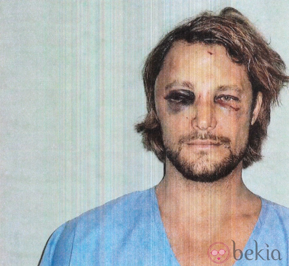 Gabriel Aubry muestra su rostro tras la pelea con Olivier Martínez