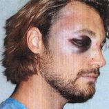 Gabriel Aubry con el ojo morado tras la pelea con Olivier Martínez