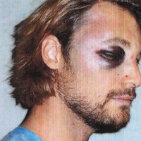 Gabriel Aubry con el ojo morado tras la pelea con Olivier Martínez