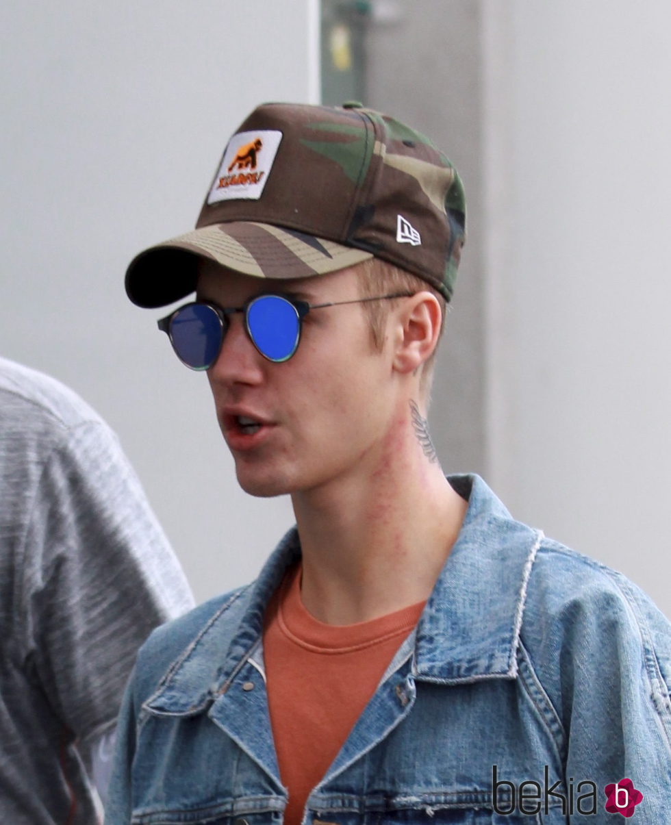 Justin Bieber con una importante erupción en el cuello